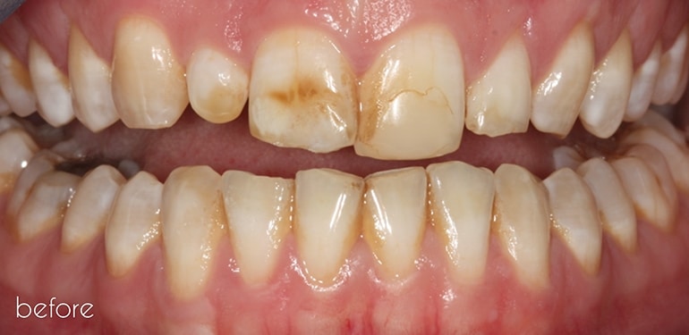 Before dental treatment at Park Dental Care Before dental treatment at Park Dental Care