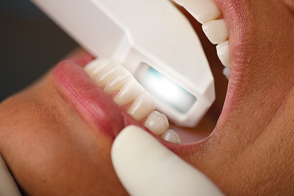 Invisalign scan dentist loughborough