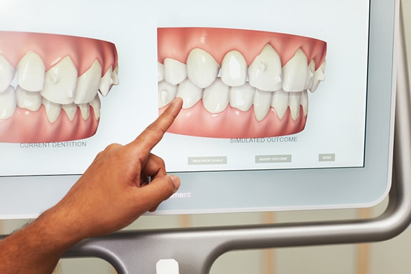 Invisalign scan dentist loughborough